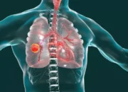 Mengenal Penyakit Kanker Paru dan Pencegahannya