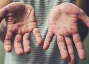 HFMD Penyakit Yang Mulai Menyebar Dan Perlu Diperhatikan